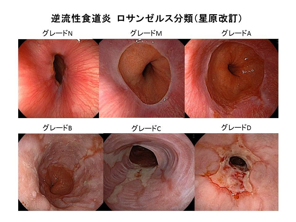 逆流性食道炎